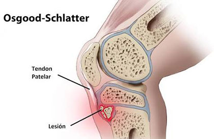 Enfermedad de osgood-schlatter